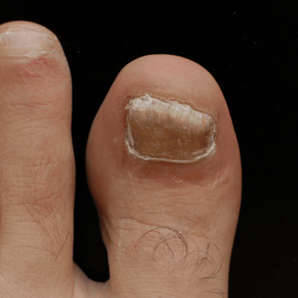 ToeFix Nail Repair Patches